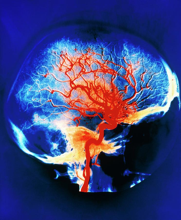 Cerebral Arteries Photograph by Alain Pol, Ism/science Photo Library