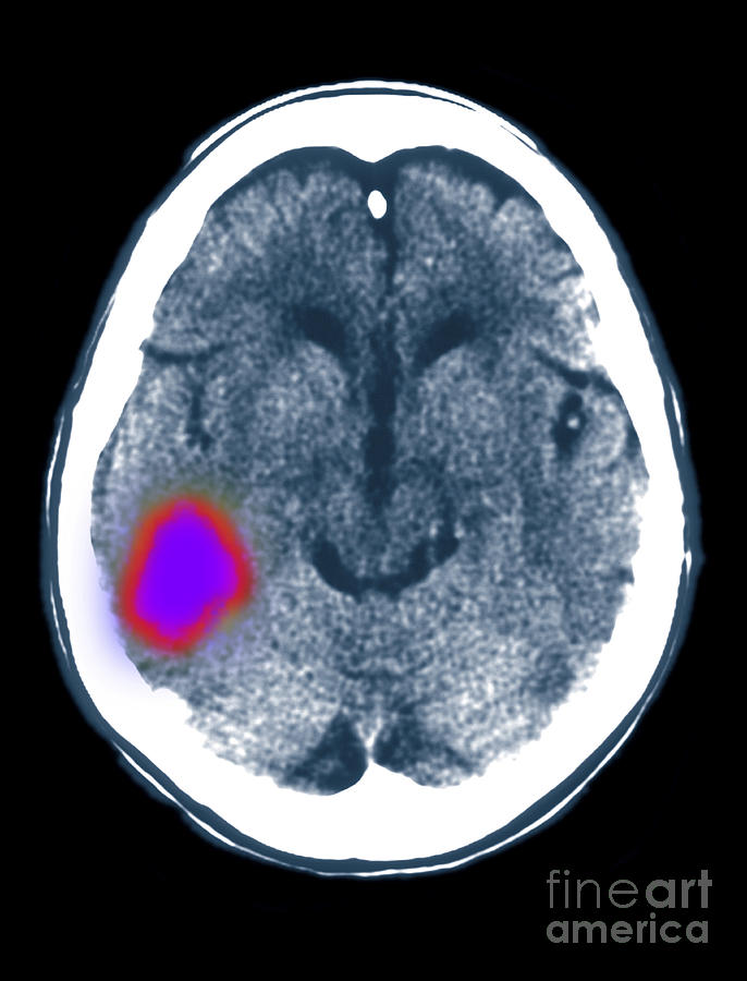 Cerebral Ct Scan Showing Stroke Photograph by Scott Camazine