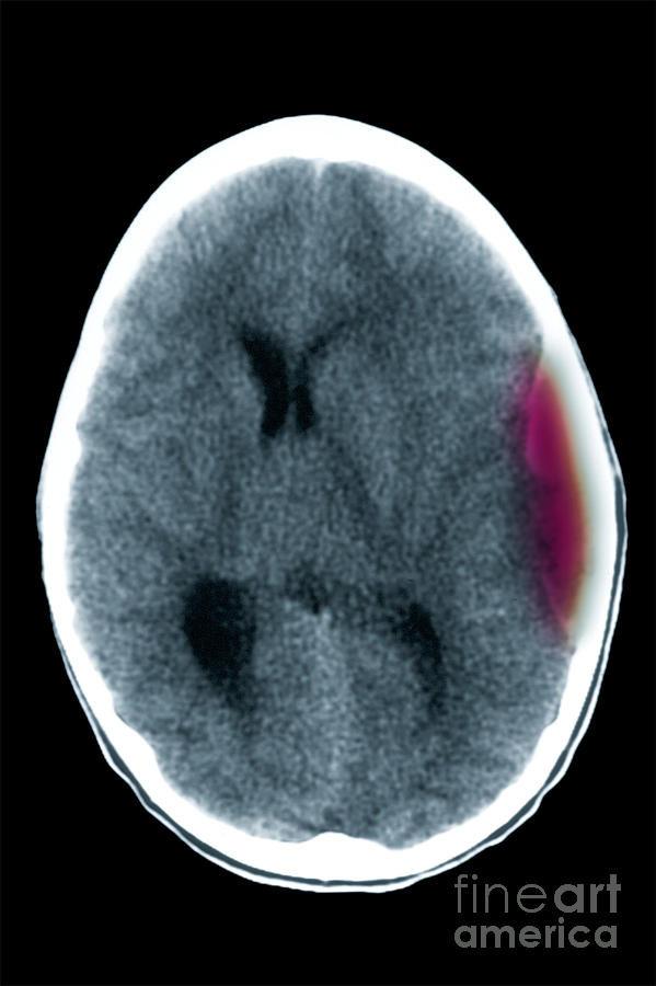 Cerebral Ct Showing Subdural Hematoma Photograph by Scott Camazine