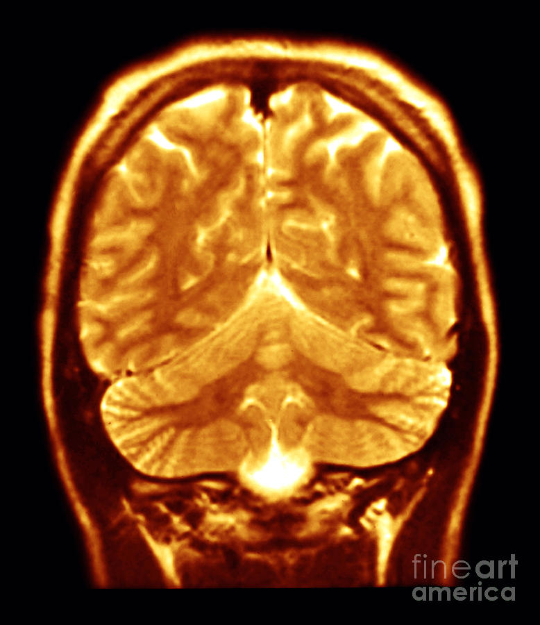 Cerebral Mri Photograph by Scott Camazine