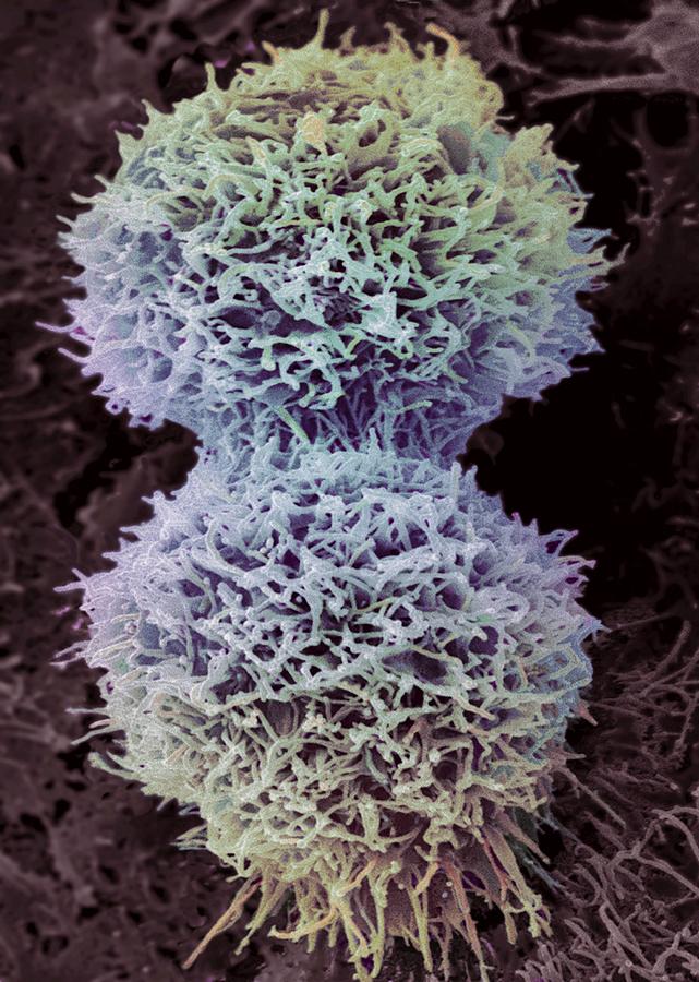 Cervical cancer cell Photograph by Science Photo Library - STEVE GSCHMEISSNER.