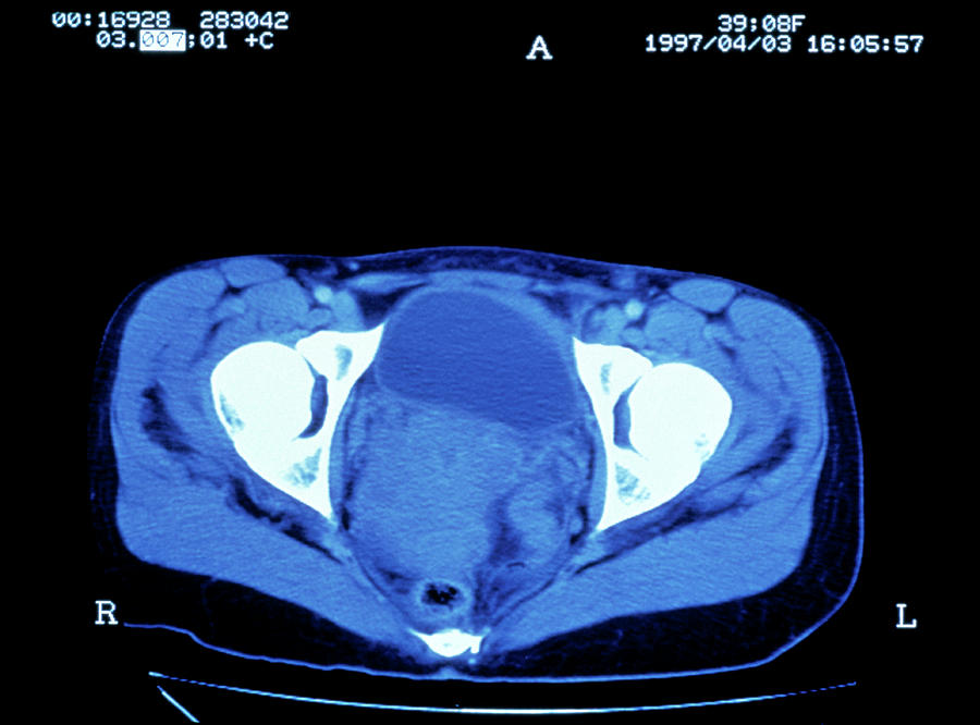 Cervical Cancer Ct Scan Photograph by Science Photo Library - Fine Art