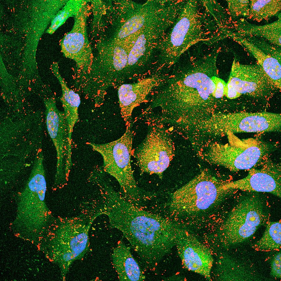 Cervical Cancer Metastasis Research Photograph by Winship Cancer Institute Of Emory University/national Cancer Institute/science Photo Library