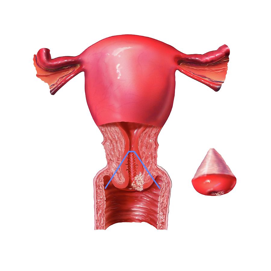 Cervical Conization Photograph by Bo Veisland/science Photo Library ...