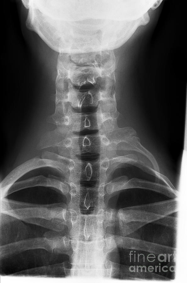 ap cervical spine x ray