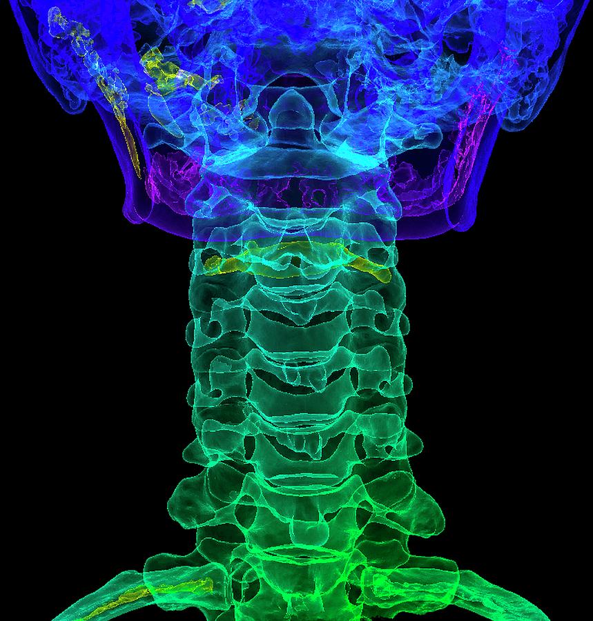 Cervical Spine Anatomy Photograph by K H Fung/science Photo Library