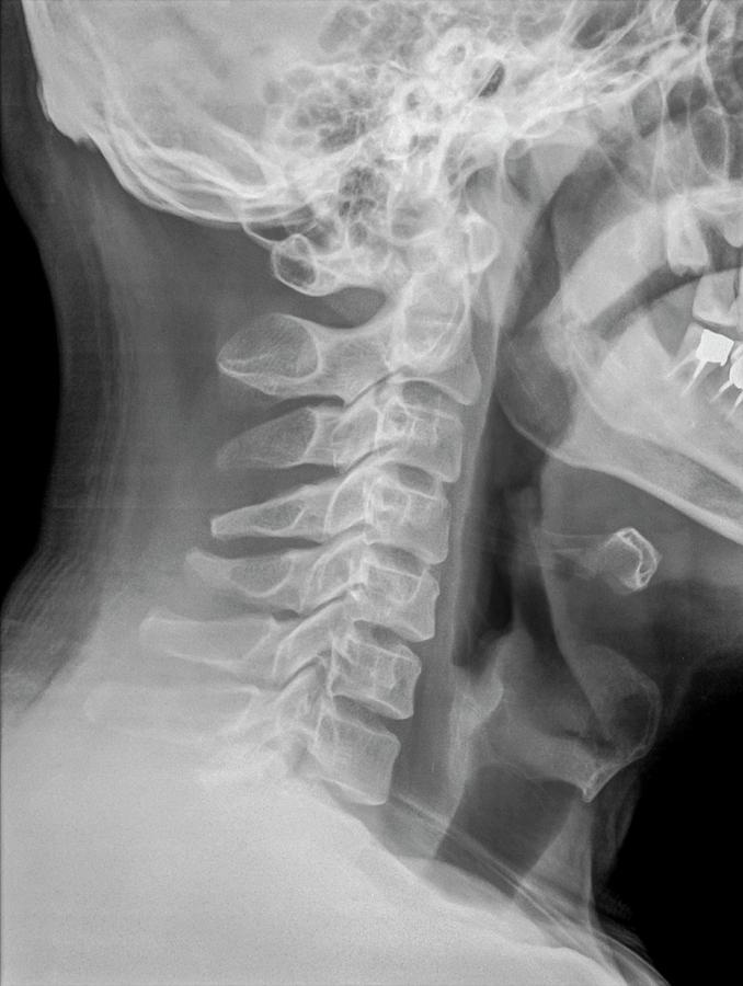 cervical spine abnormal x ray