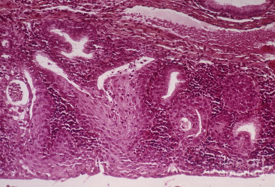 Disease Photograph - Cervical Squamous Metaplasia by Dr. F. Coupez, Cnri