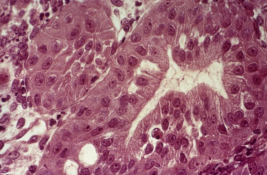 Disease Photograph - Cervical squamous metaplasia by Science Photo Library