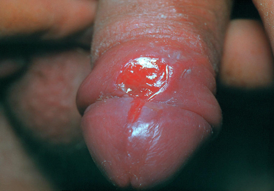 Chancre (sore) On Penis Due To Primary Syphilis Photograph by Science Photo Library