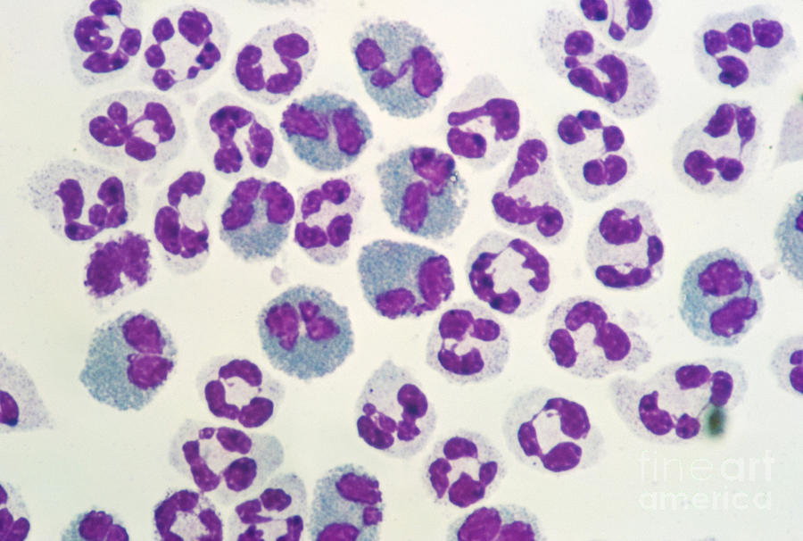 Chediak-higashi Disease Photograph by Dr. Cecil H. Fox
