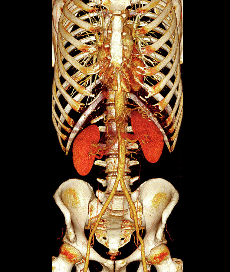 Chest And Abdomen Ct Scan Photograph by Antoine Rosset/science Photo ...