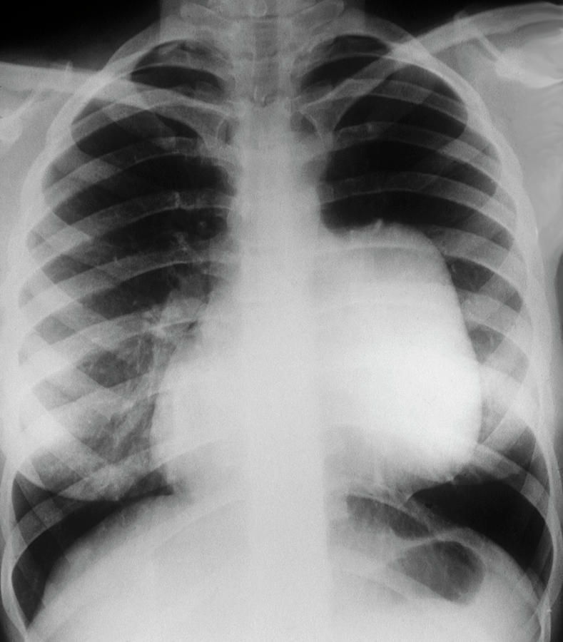 Chest Tumour Photograph by Zephyr/science Photo Library - Pixels