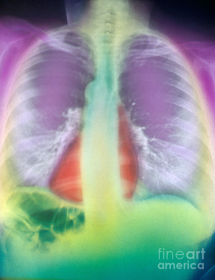 Chest X-ray Photograph by Chris Bjornberg