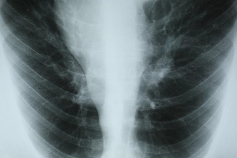 Chest x-ray image on light table showing of a patient’s lungs and respiratory tract Photograph by Douglas Sacha