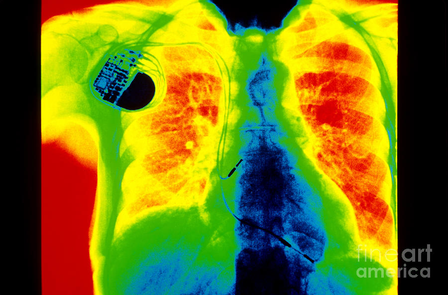 Chest X-ray Showing Pacemaker Photograph by Scott Camazine