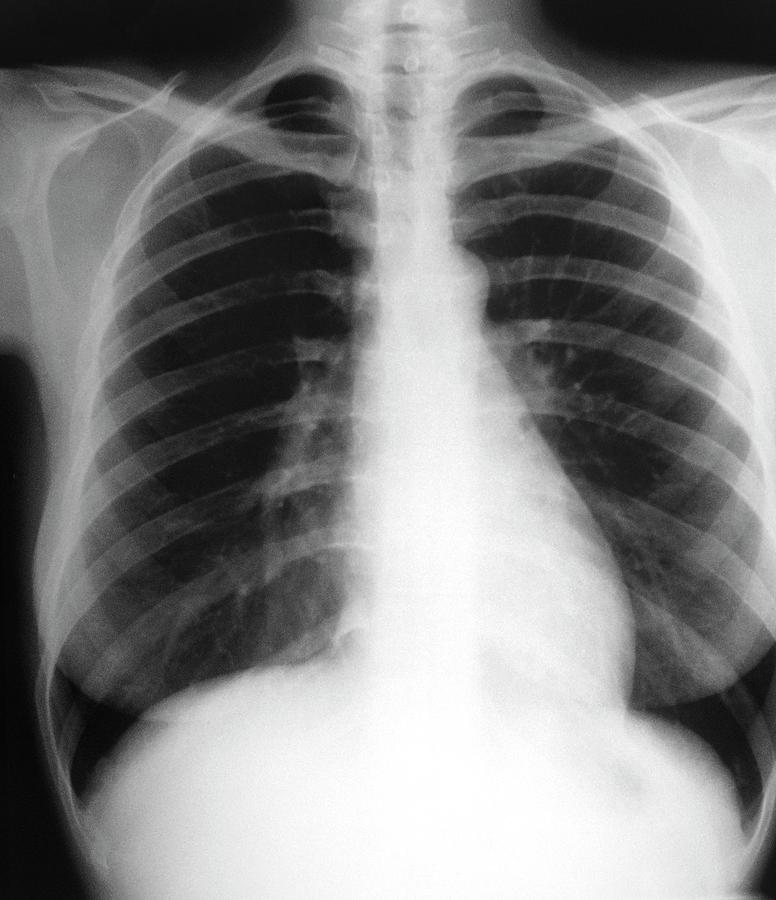 Chest X-ray Showing The Lungs Photograph by Science Photo Library. - Pixels