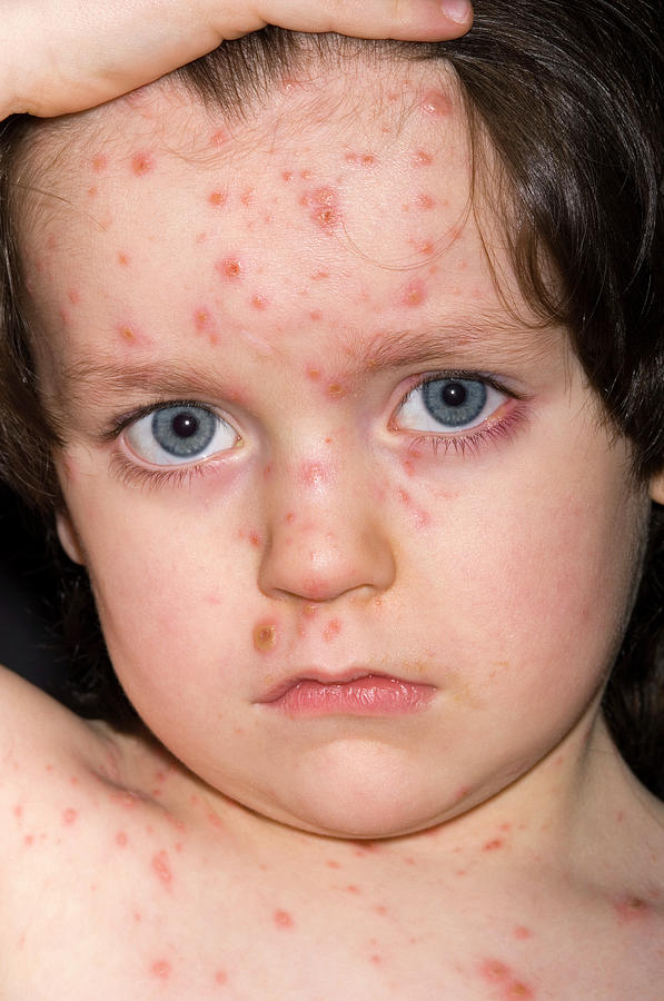 Chicken Pox Lesions On Face Photograph by Dr P. Marazzi/science Photo