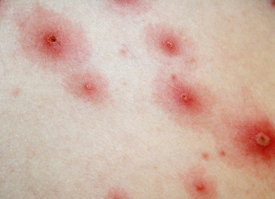 chicken pox and shingles