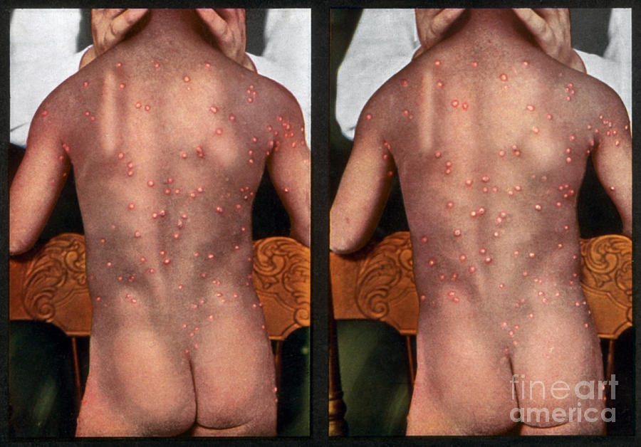 Chickenpox, Vintage Stereoscopic Image Photograph by DoubleVision