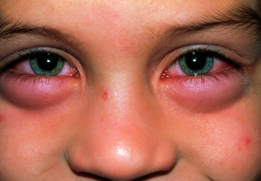 Do You Get Red Eyes From Allergies