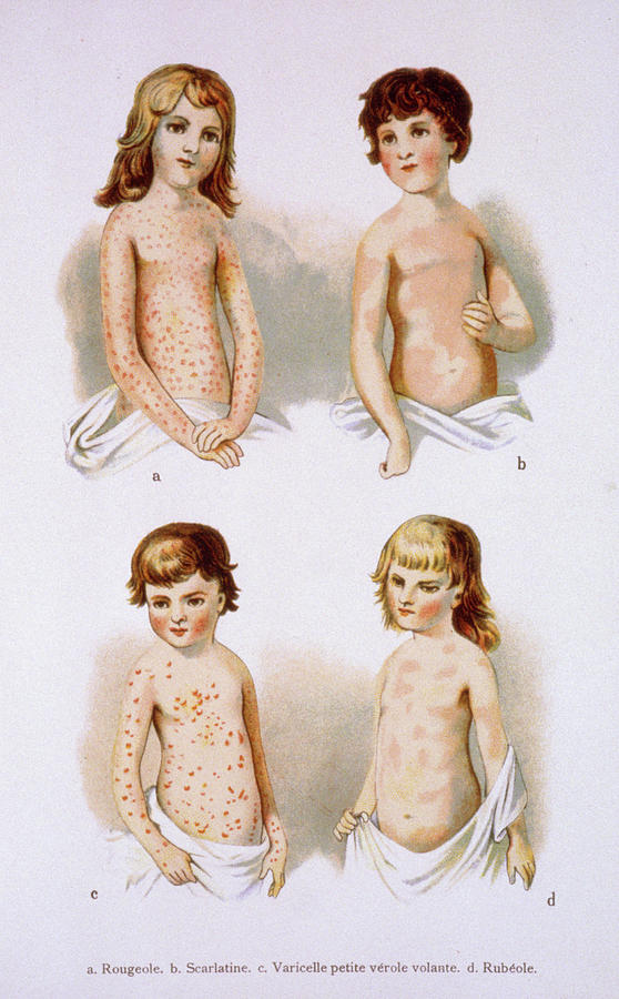 Chicken-pox Photograph - Childhood Diseases by Jean-loup Charmet/science Photo Library