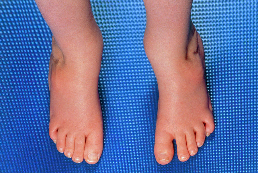 Childs Feet With Talipes (club Foot) Deformity Photograph by Medical Photo Nhs Lothian/science Photo Library