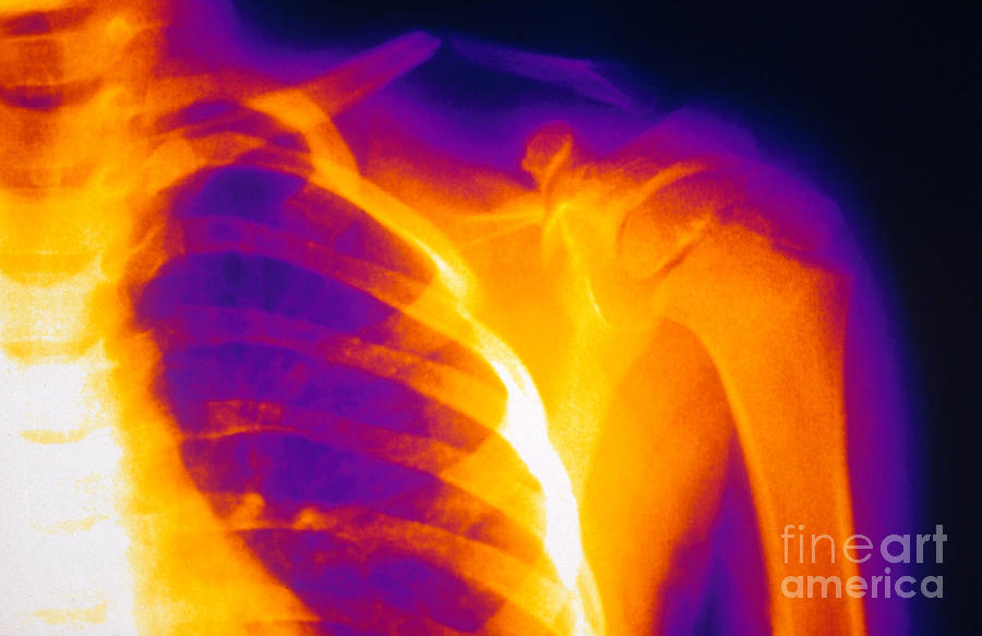 Childs Fractured Clavicle, X-ray Photograph by Scott Camazine