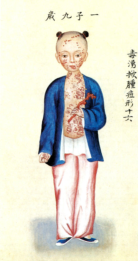 Chinese Smallpox Victim Photograph by Science Source