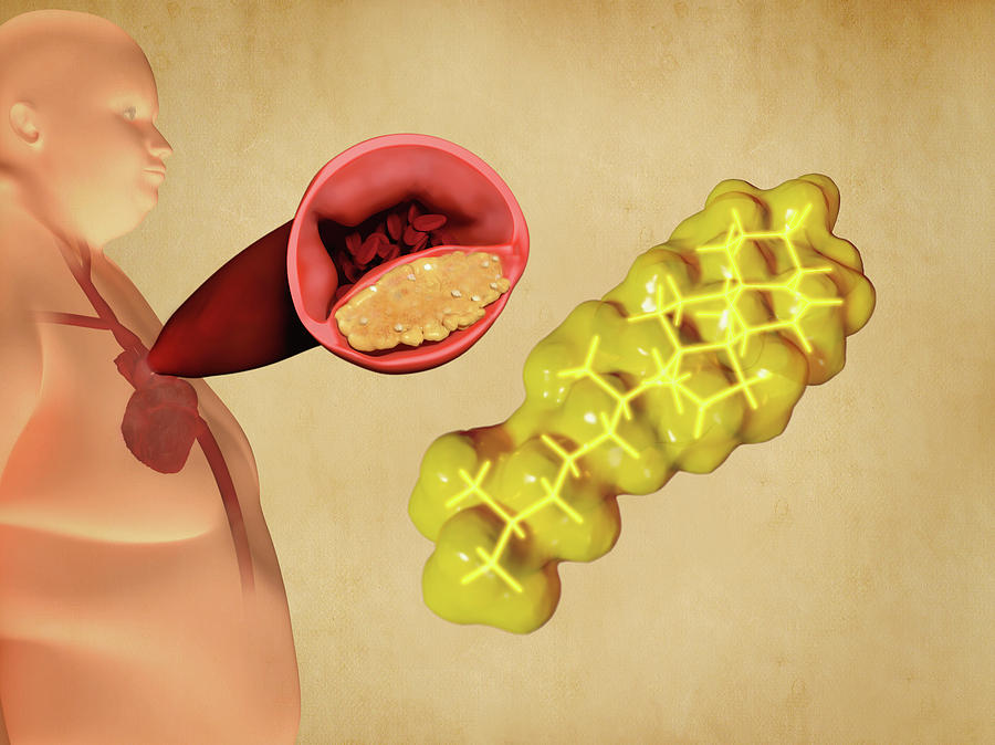 Cholesterol And Atherosclerosis, Artwork Photograph by Juan Gaertner