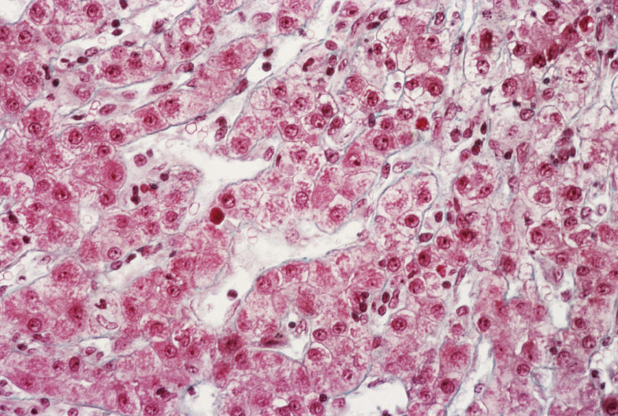 Chronic Active Hepatitis Photograph By Cnri Science Photo Library