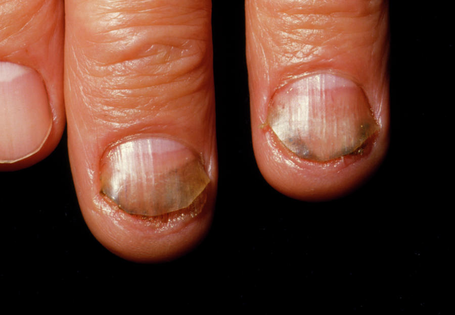 Chronic Fungal Infection Of Fingernails Photograph By Dr H.c.robinson 