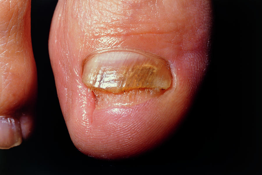 8. Big Toe Nail Color Change and Fungal Infections - wide 7