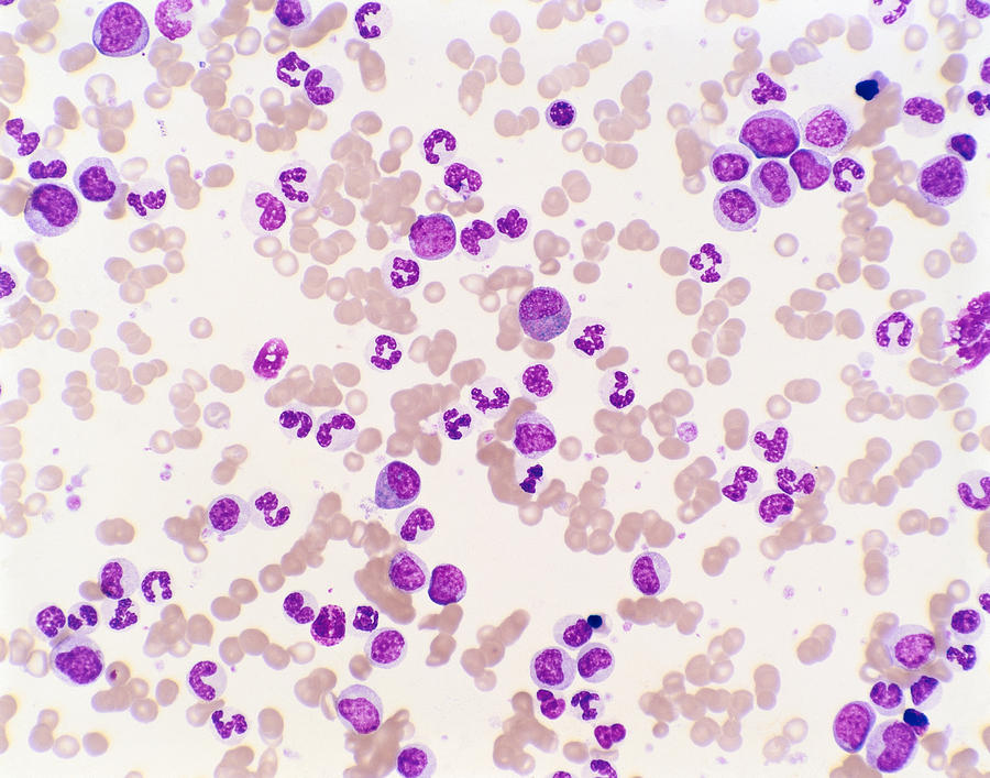 Chronic Granulocytic Leukemia Photograph by Joaquin Carrillo-Farga