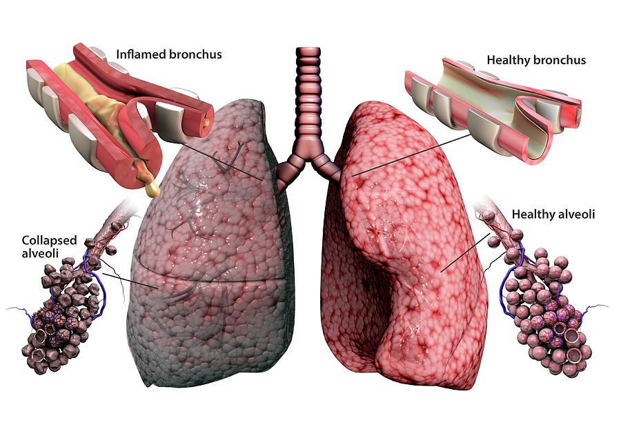 Chronic Obstructive Pulmonary Disease Photograph By Gunilla Elamscience Photo Library Pixels