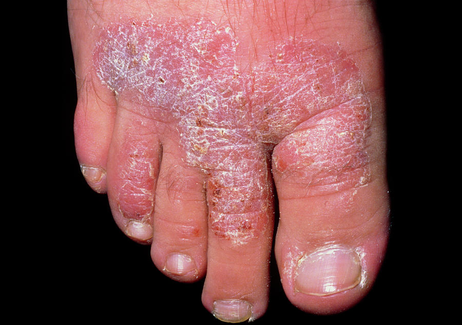 psoriasis feet