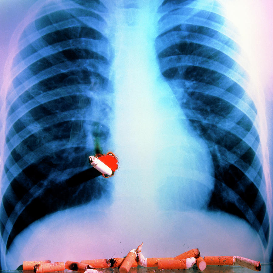 Cigarette Burning A Hole Through X-ray Of Lungs Photograph by Sheila ...