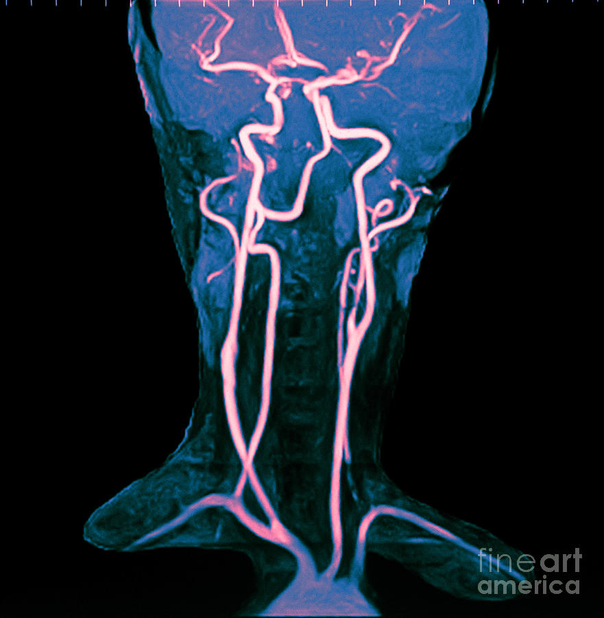 Circle Of Willis Photograph by Susan Leavines