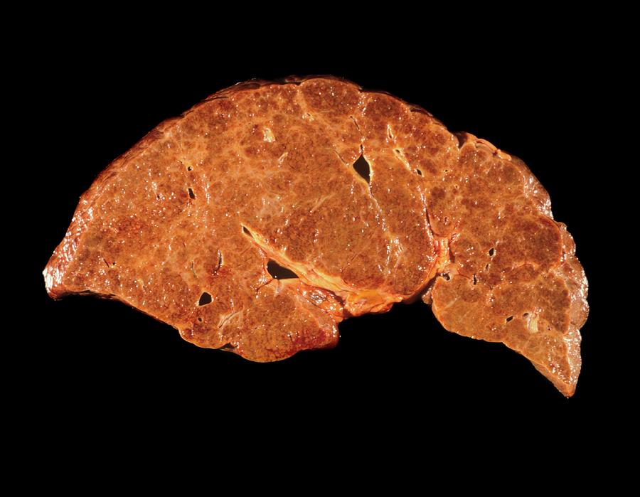 Cirrhotic Liver Photograph by Cnri/science Photo Library - Pixels