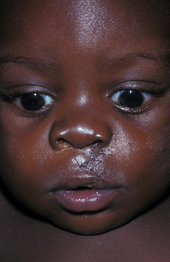 Cleft Lip Photograph by Dr M.a. Ansary/science Photo Library