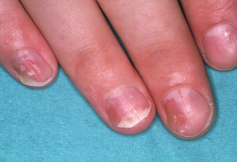 Close Of Psoriasis Causing Pitting Of Fingernails Photograph by Science ...