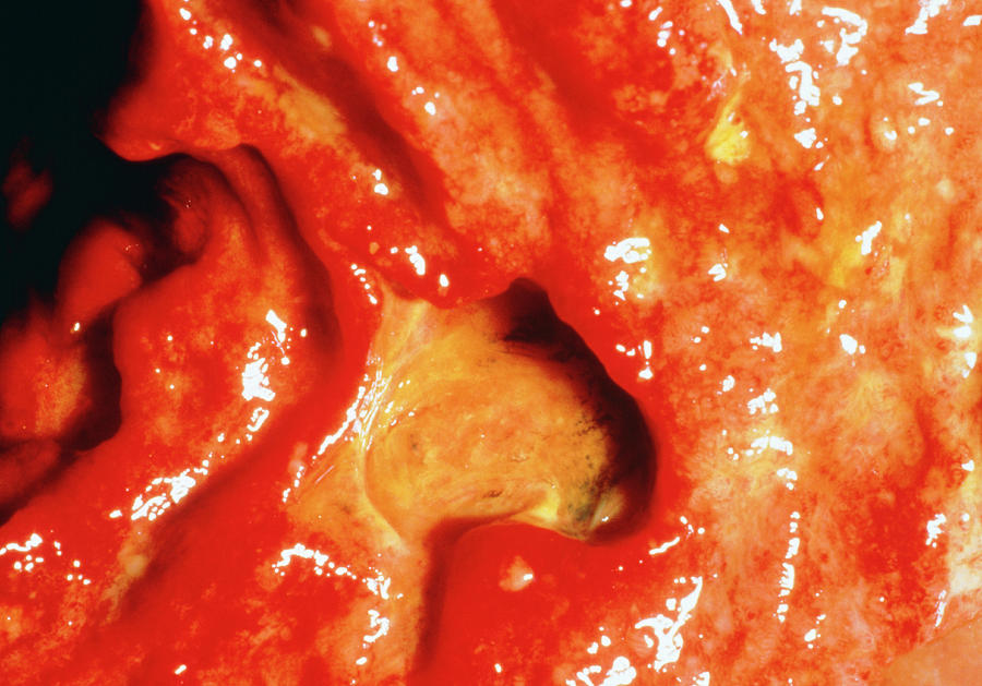 Ulcer Photograph - Close-up Clinical Shot Of Duodenal Ulcer by Dopamine/science Photo Library
