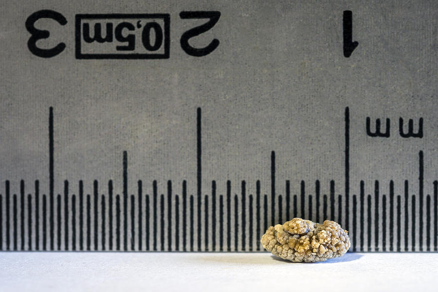 Close-up detail of a kidney stone due to nephritic colic, with a ruler from behind to measure its size. Photograph by Javier Fernández Sánchez