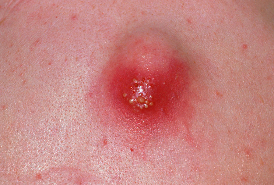 A skin cyst is nor harmful unless it becomes infected