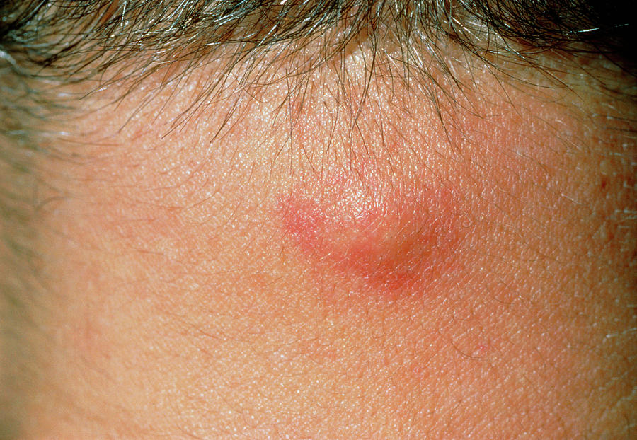 close-up-inflamed-sebaceous-cyst-on-male-neck-photograph-by-science