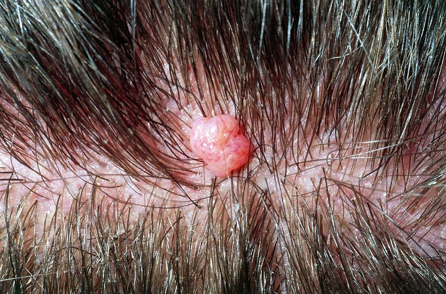 Close-up Of A Benign Mole On Scalp Of Young Man Photograph by Dr P ...