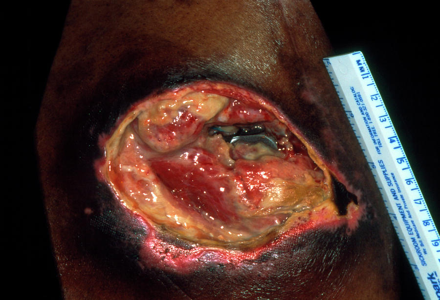 Sore Photograph - Close-up Of A Very Large Ulcer On A Patients Skin by Stevie Grand/science Photo Library