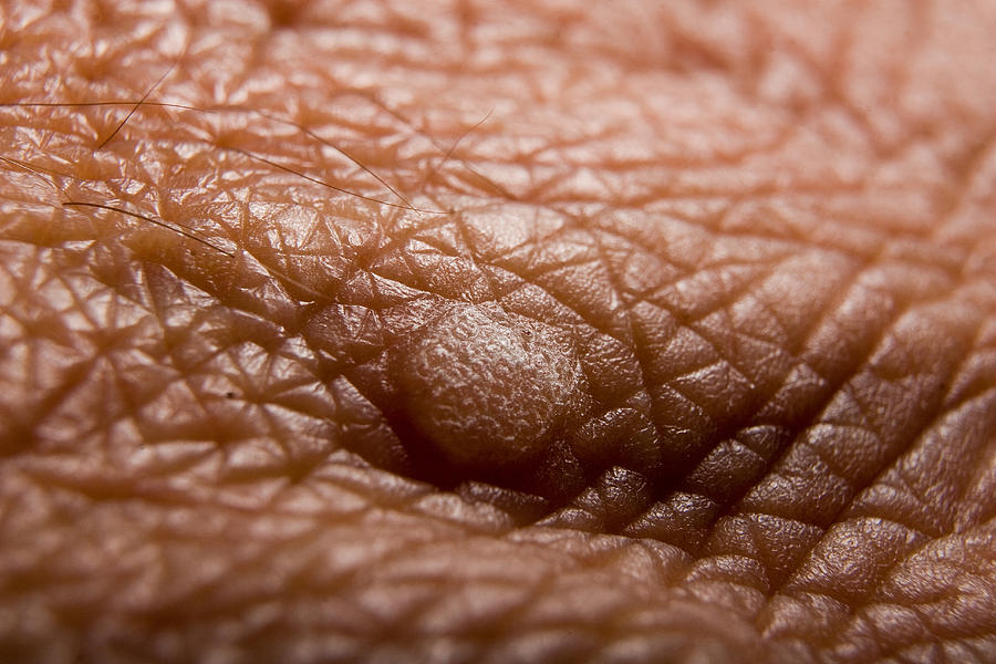 Close-up of a wart on a persons skin Photograph by WIN-Initiative/Neleman