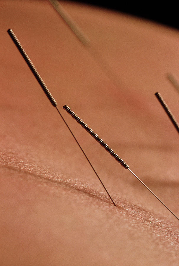 close up of acupuncture needles in skin andrew mcclenaghanscience photo library