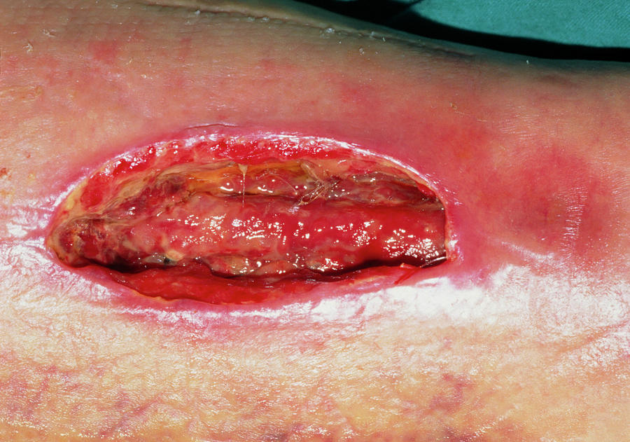 Close Up Of An Open And Infected Leg Wound Photograph by Garry Watson/science Photo Library